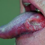 Oral Cancer