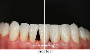 untitlBioclear