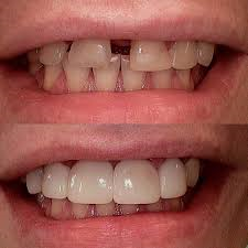 diastema