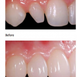 Peg Laterals and Bioclear