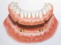 lower-denture