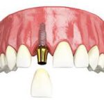 Single Tooth Implants