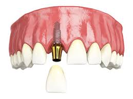 single-tooth-implant