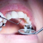 Dental Amalgam-New Regulations