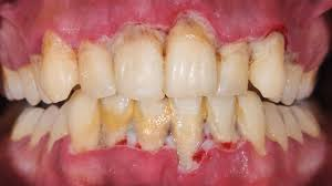 gum-disease