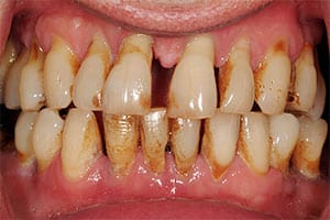 gum-disease